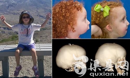 美国西雅图一名7岁女童莱克西，因早产出生，下颚畸形细小。