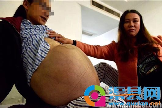 大叔怀“怪胎”3年似孕妇 系60斤巨大肿瘤(图)