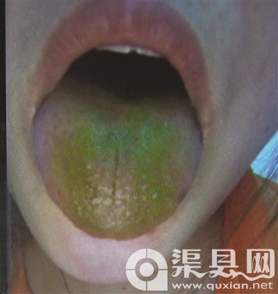 变绿的舌苔