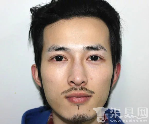 有渠县的，在重庆做过双眼皮的吗？求介绍。就这样的