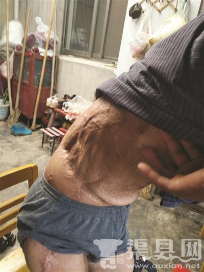 南京男子2年前捡到“铱链” 受辐射落下终身残疾