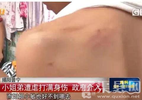 广东揭阳十几岁姐弟被亲爹继母虐打7年体无完肤