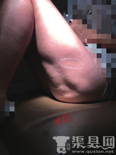北京医院回应“女子丰臀失败致大腿凹凸不平”