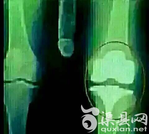 今天摔了一下！
