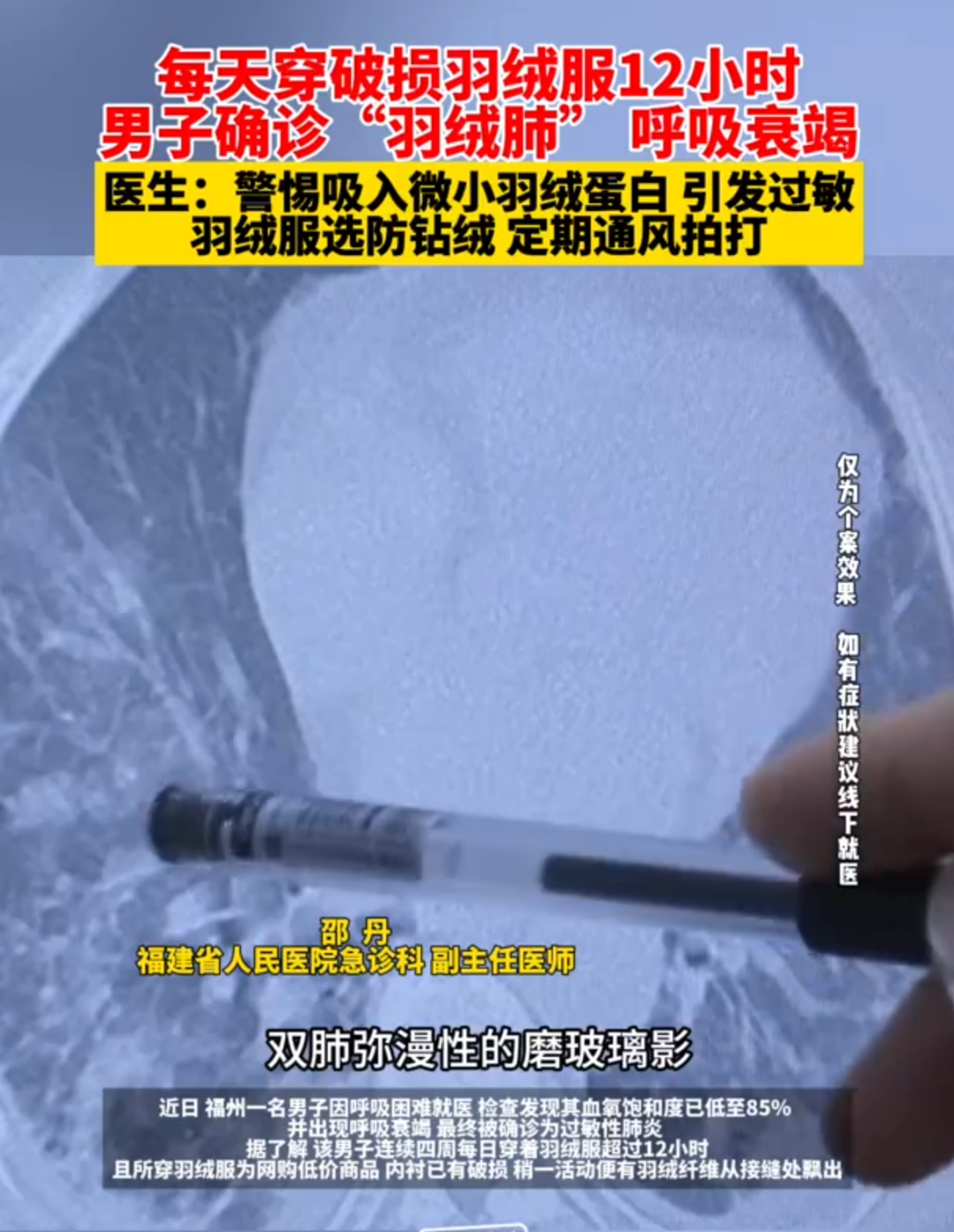 男子确诊“羽绒肺” 呼吸衰竭！医生提醒