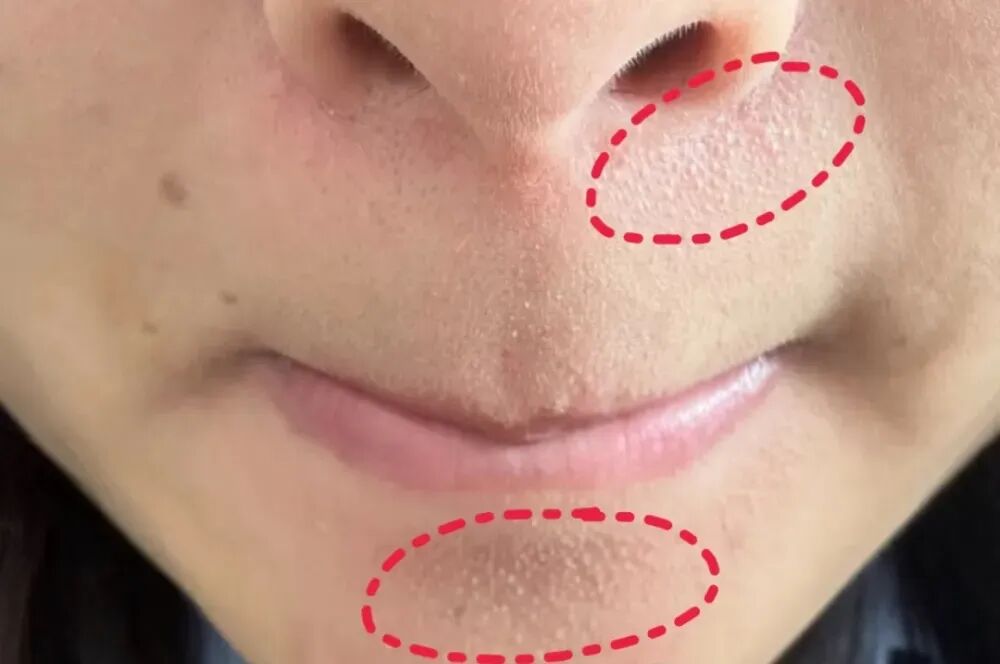 真的想问：下巴凸起的小颗粒，到底是什么呀？